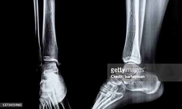 x-ray of a foot - broken heel stock-fotos und bilder