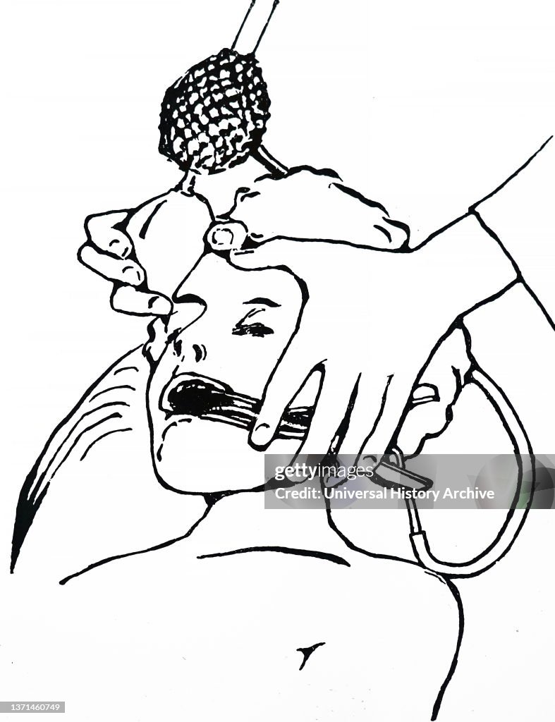 Clover's method of administering chloroform