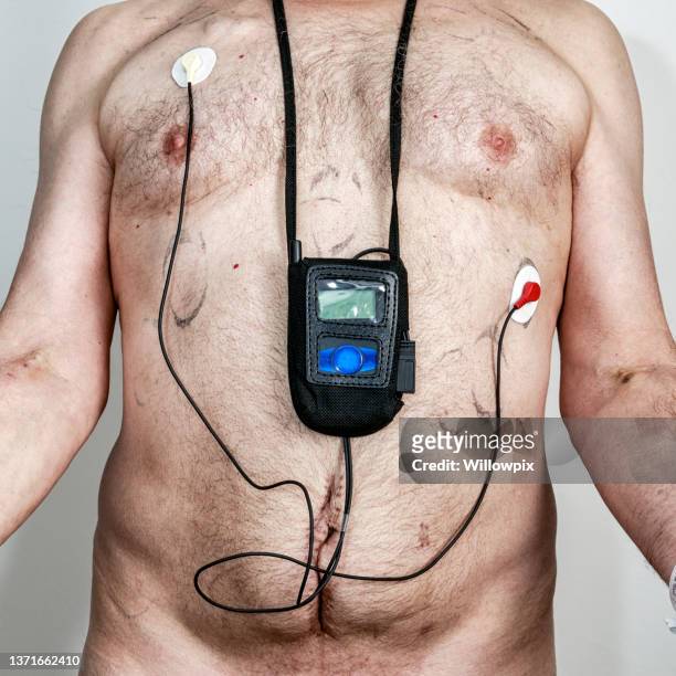 cancer chemotherapy patient wearing heart monitor - heart scar stockfoto's en -beelden