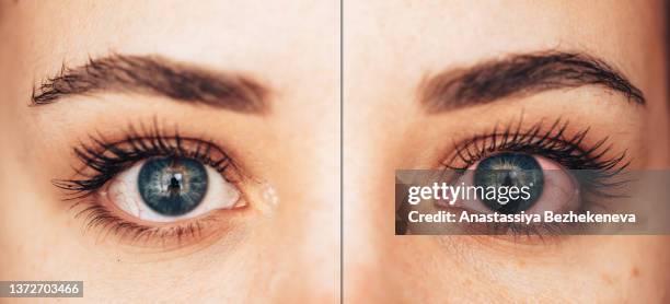 one healthy and diseased female eye in blue - red eye stock-fotos und bilder