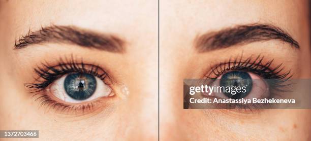 one healthy and diseased female eye in blue - eyelid foto e immagini stock