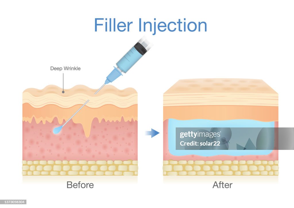 Filler Radius Injection Filler Injection Into The Skin Layer By A Needle For Beauty Surgery ...
