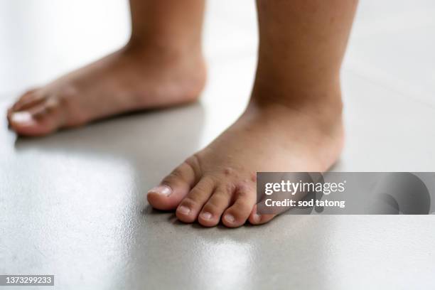 young woman the itch on her feet w/ redness rash. cause of itchy skin include athlete's foot (fungal infection), dermatitis (eczema), psoriasis, or bug bites. health care. copy space. - hand eczema stock pictures, royalty-free photos & images