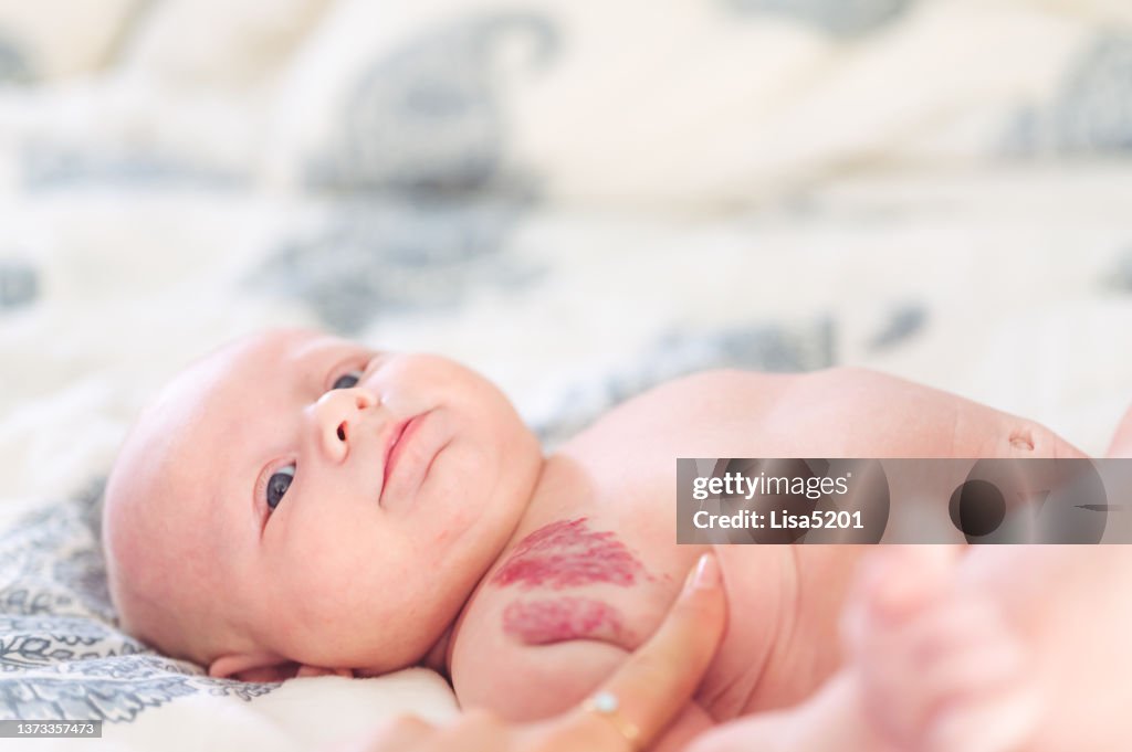 Cute little baby boy with hemangioma marks on his shoulder, infant birth marks