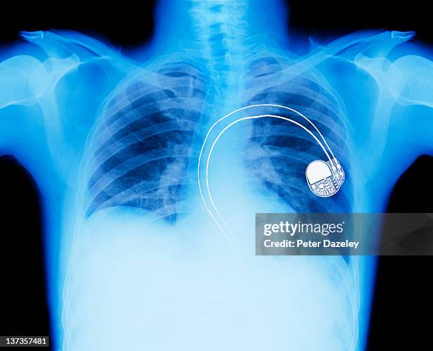 Foto Pacemaker Pacemaker Xray Foto e immagini stock - Getty Images