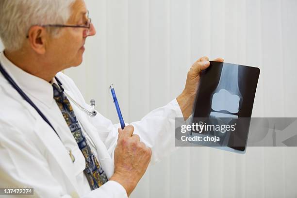 doctor is examining x-ray image of artificial knee - knee replacement stock pictures, royalty-free photos & images