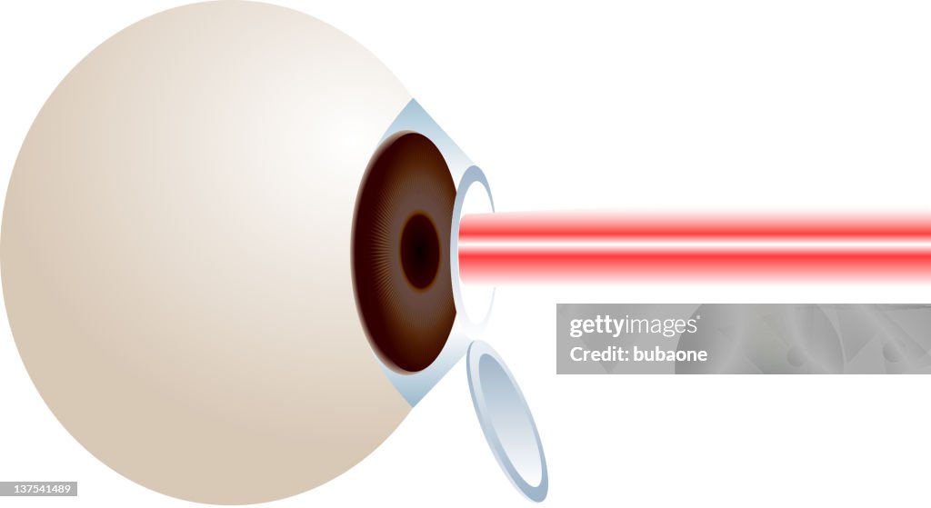 Lasik surgery on the eye