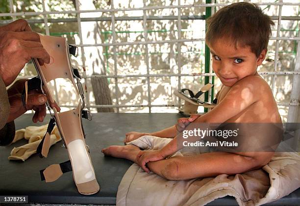 Pollio Examples People With Polio Legs