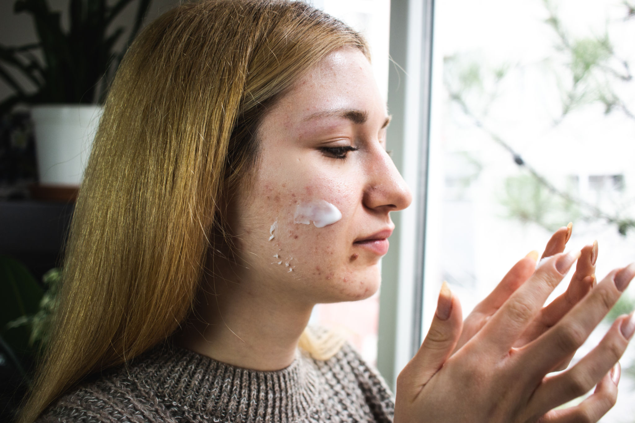 acne treatment