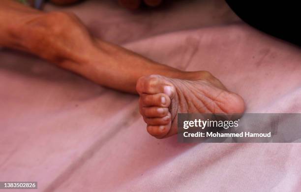 The leg of a Yemeni child who suffers from malnutrition is seen during treatment at an anti-malnutrition center in a hospital on March 9, 2022 in...