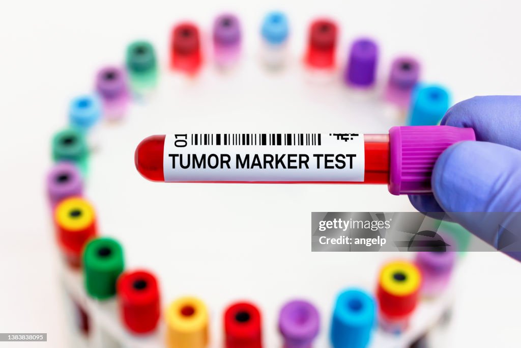 Doctor with blood tube labeled with Tumor marker for analysis of cancer biomarkers test