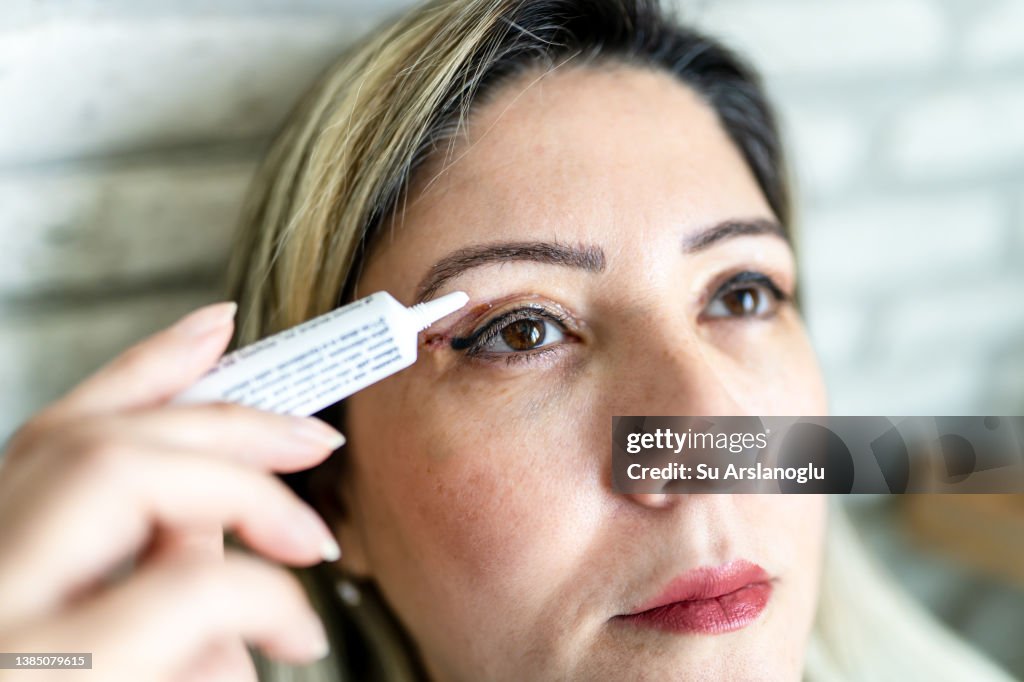 Woman having eyelid surgery applies eye cream at home