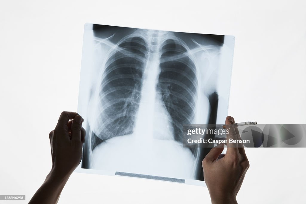 Hands holding a chest x-ray and a cigarette, close-up