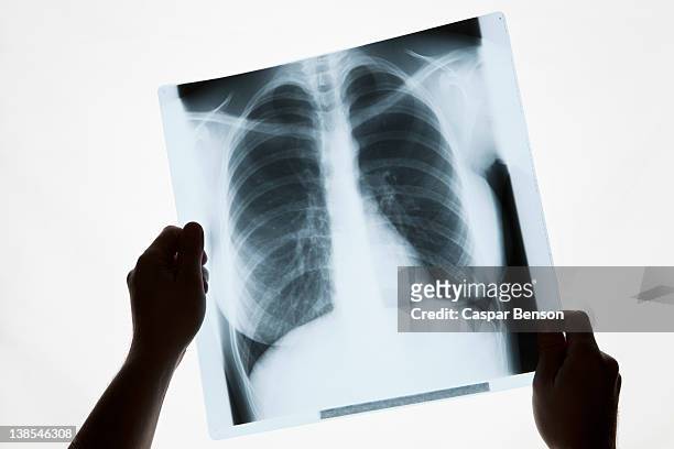 hands holding a chest x-ray, close-up - röntgen stock-fotos und bilder