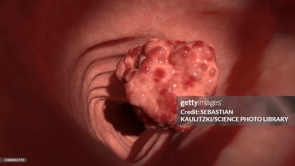 Colon tumour, illustration