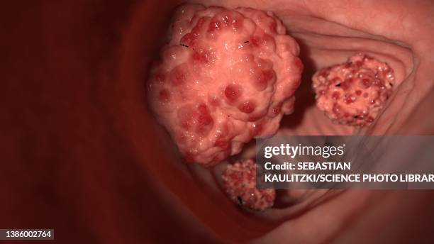 colon tumours, illustration - ulcerative colitis stock illustrations