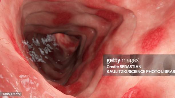 ulcerative colitis, illustration - ulcerative colitis stock illustrations