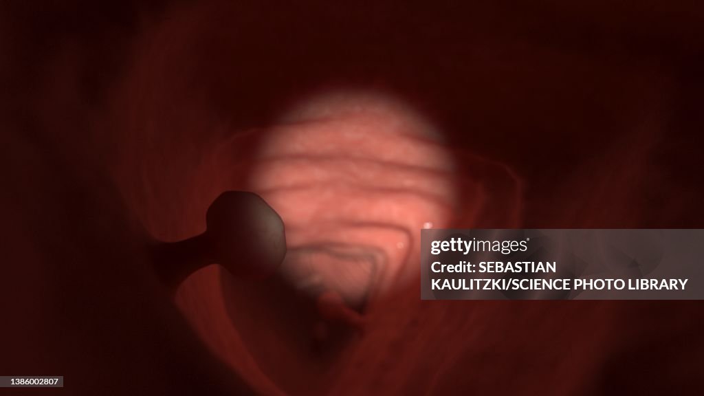 Polyps Animation Colon Polyp Illustration High-Res Vector Graphic - Getty Images