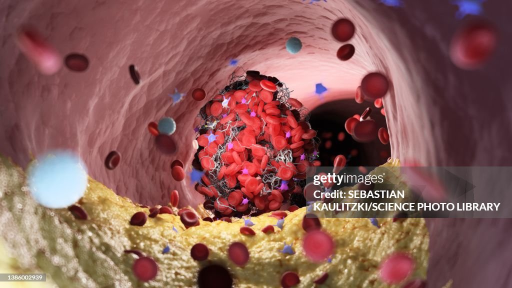 Blood clot, illustration