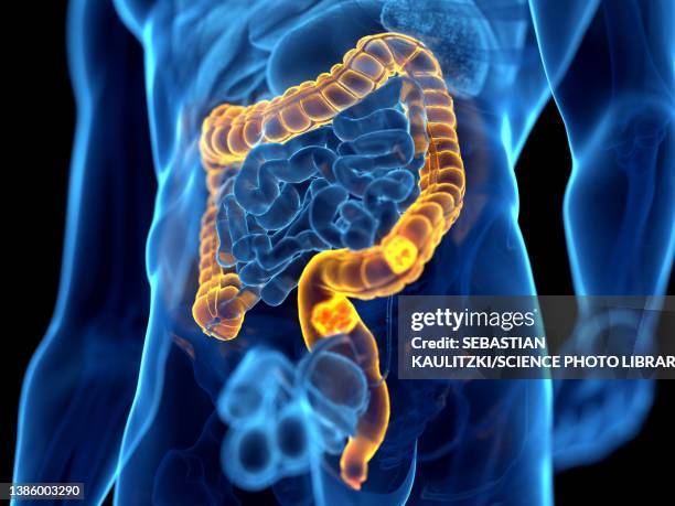 illustrations, cliparts, dessins animés et icônes de colon cancer, illustration - cancer colorectal