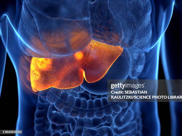 liver cancer, illustration - hepatitis stock-grafiken, -clipart, -cartoons und -symbole