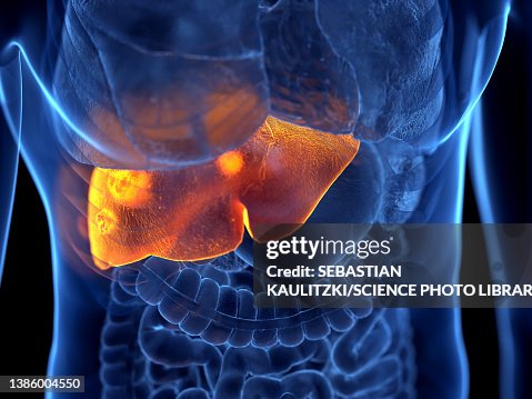 Liver cancer, illustration Liver cancer, illustration