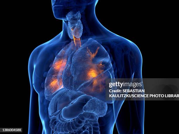 lung cancer, illustration - mukoviszidose stock-grafiken, -clipart, -cartoons und -symbole
