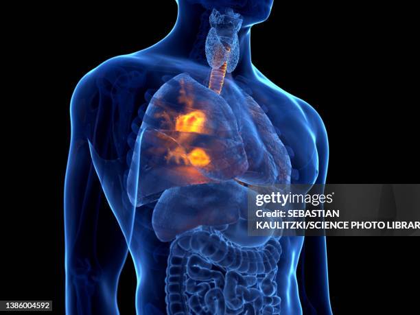 lung cancer, illustration - copd stock illustrations