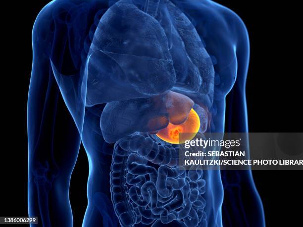 ilustraciones, imágenes clip art, dibujos animados e iconos de stock de stomach cancer, illustration - ulcer