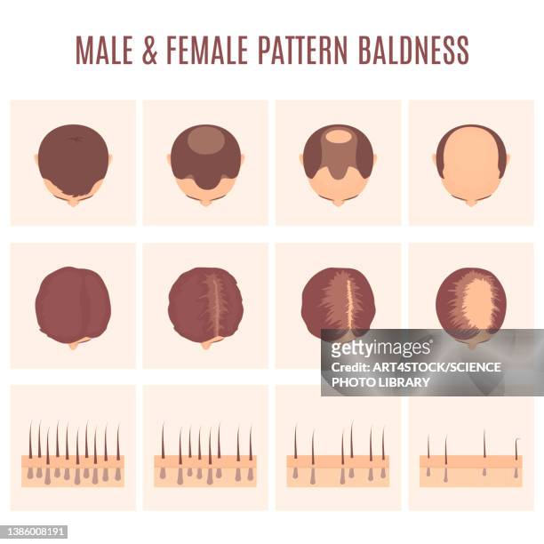 ilustraciones, imágenes clip art, dibujos animados e iconos de stock de male and female hair loss patterns, conceptual illustration - human scalp