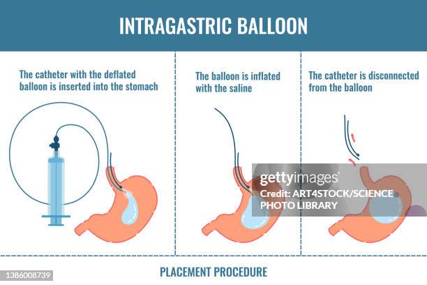 gastric balloon, conceptual illustration - 内視鏡点のイラスト素材／クリップアート素材／マンガ素材／アイコン素材