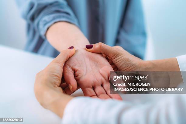 examining the hand of a patient with carpal tunnel syndrome - karpaltunnelsyndrom bildbanksfoton och bilder