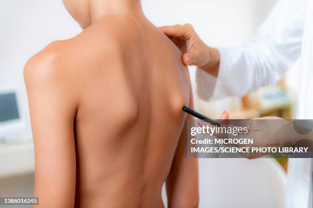 pediatric doctor examining posture of a boy - escapula fotografías e imágenes de stock
