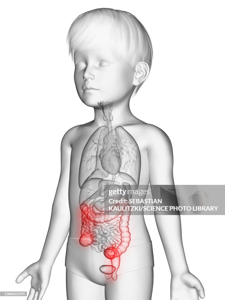 Illustration of a boy's colon