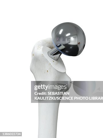Hip replacement, illustration Hip replacement, illustration