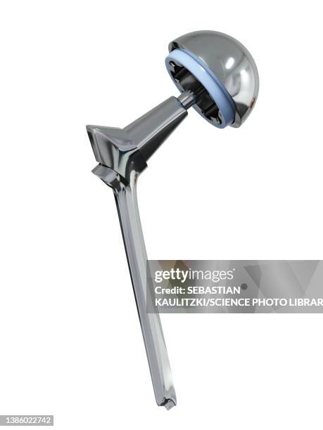 hip replacement, illustration - prosthetic technology stock illustrations