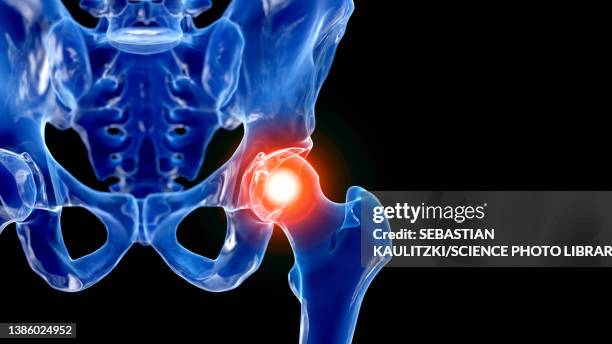 illustrazioni stock, clip art, cartoni animati e icone di tendenza di painful hip joint, illustration - fisioterapia