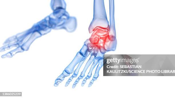 illustrazioni stock, clip art, cartoni animati e icone di tendenza di painful ankle, illustration - fisioterapia