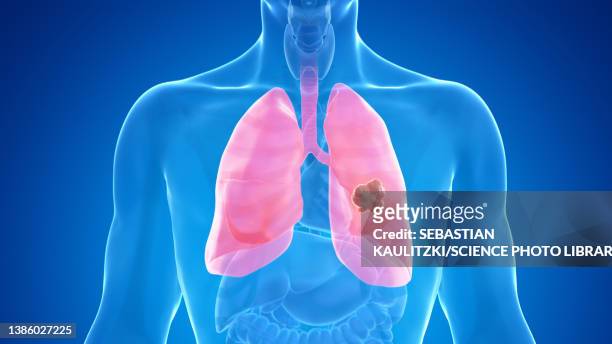 lung cancer, illustration - metastatic tumour stock-grafiken, -clipart, -cartoons und -symbole
