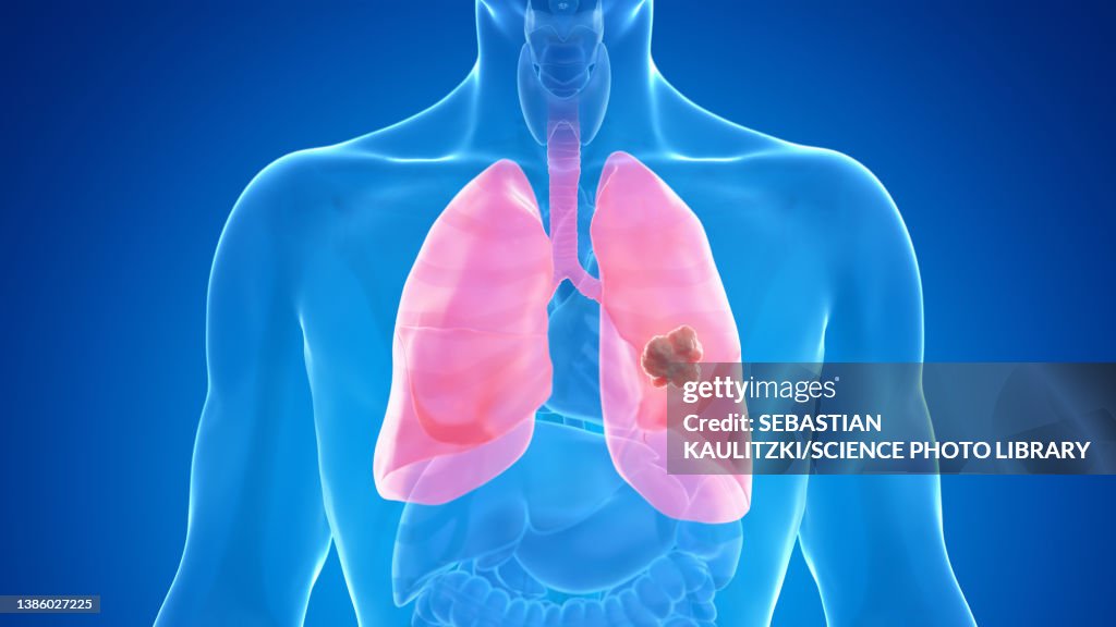 Lung cancer, illustration