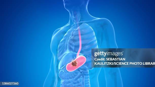 stomach cancer, illustration - magen eines menschen stock-grafiken, -clipart, -cartoons und -symbole