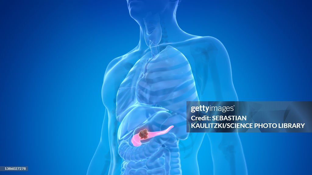 Pancreas cancer, illustration