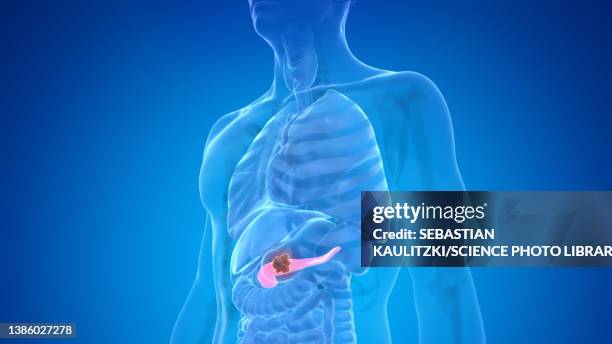 pancreas cancer, illustration - metastatic tumour stock illustrations