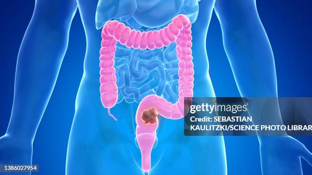 colon cancer, illustration - large intestine stock illustrations