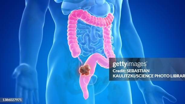 stockillustraties, clipart, cartoons en iconen met colon cancer, illustration - human digestive system