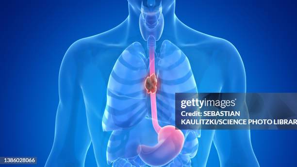 esophagus cancer, illustration - magen eines menschen stock-grafiken, -clipart, -cartoons und -symbole