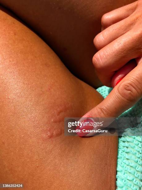 painful jellyfish sting rash on woman's leg - stinga bildbanksfoton och bilder