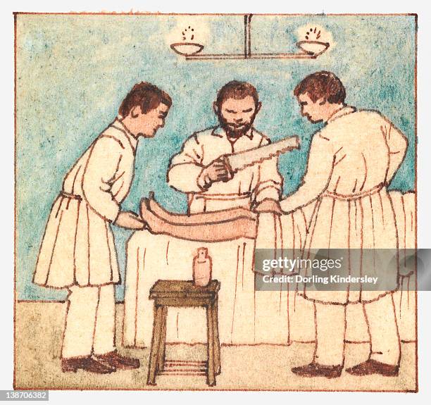 illustration of ancient surgery techniques, using saw to amputate - ancient surgery stock illustrations