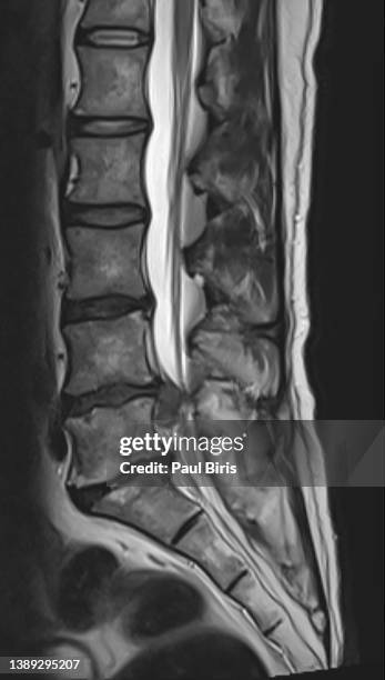 mri scan of lateral lumbar vertebral column showing l4-l5 disc herniation - herniated disc fotografías e imágenes de stock