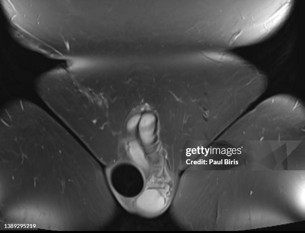 right testicular prosthesis on magnetic resonance imaging (mri), coronal view - male likeness stock pictures, royalty-free photos & images